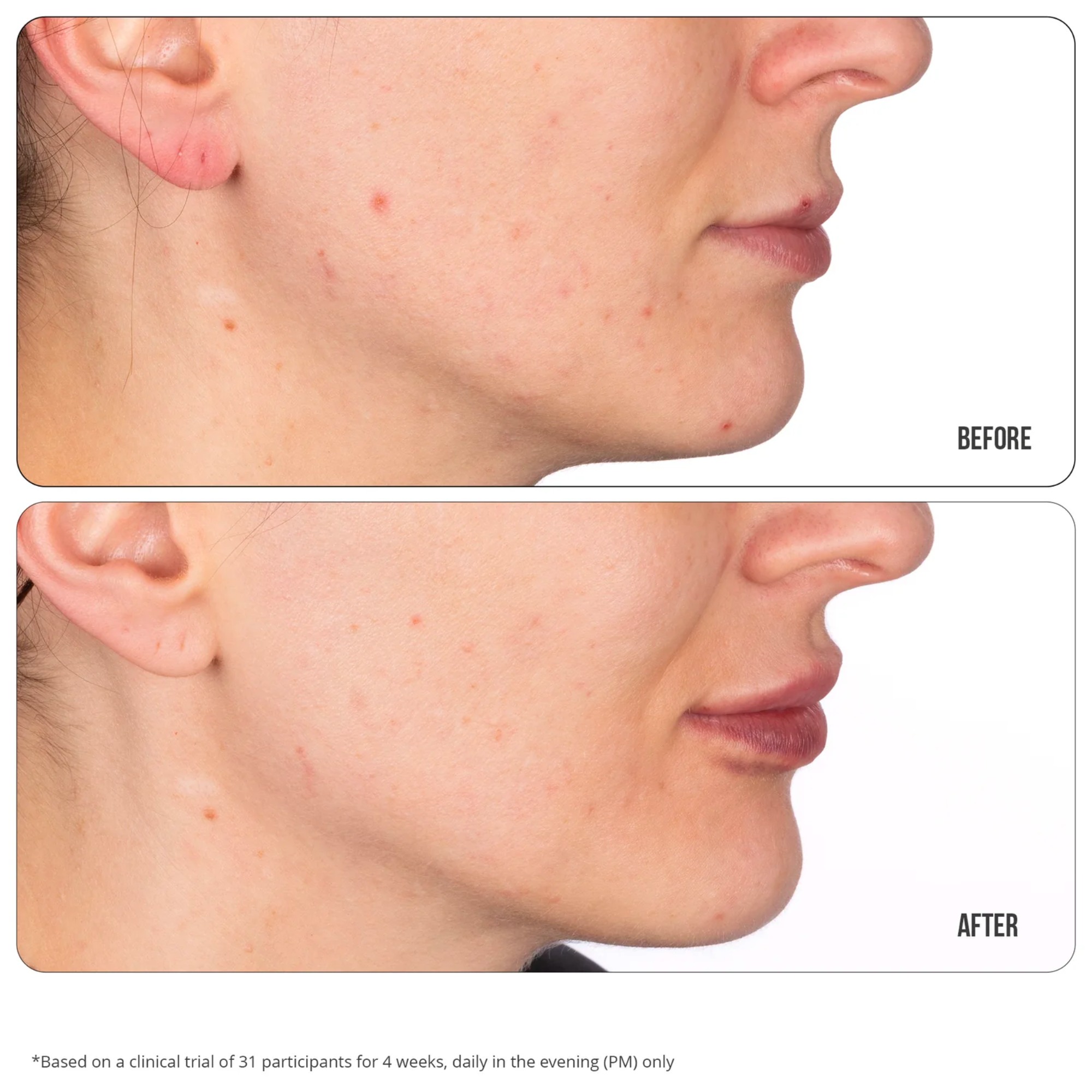 Retinol Fix Blemish Gel Treatment 10%