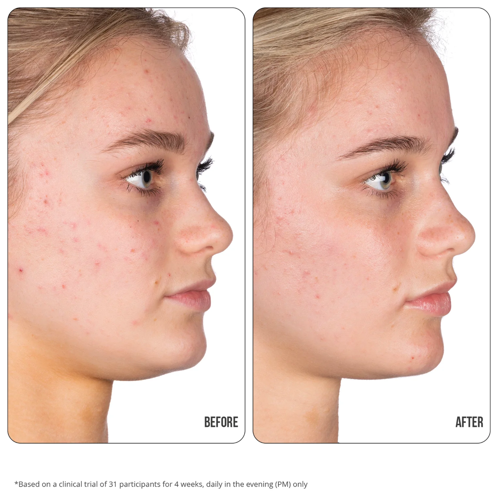 Retinol Fix Blemish Gel Treatment 10%