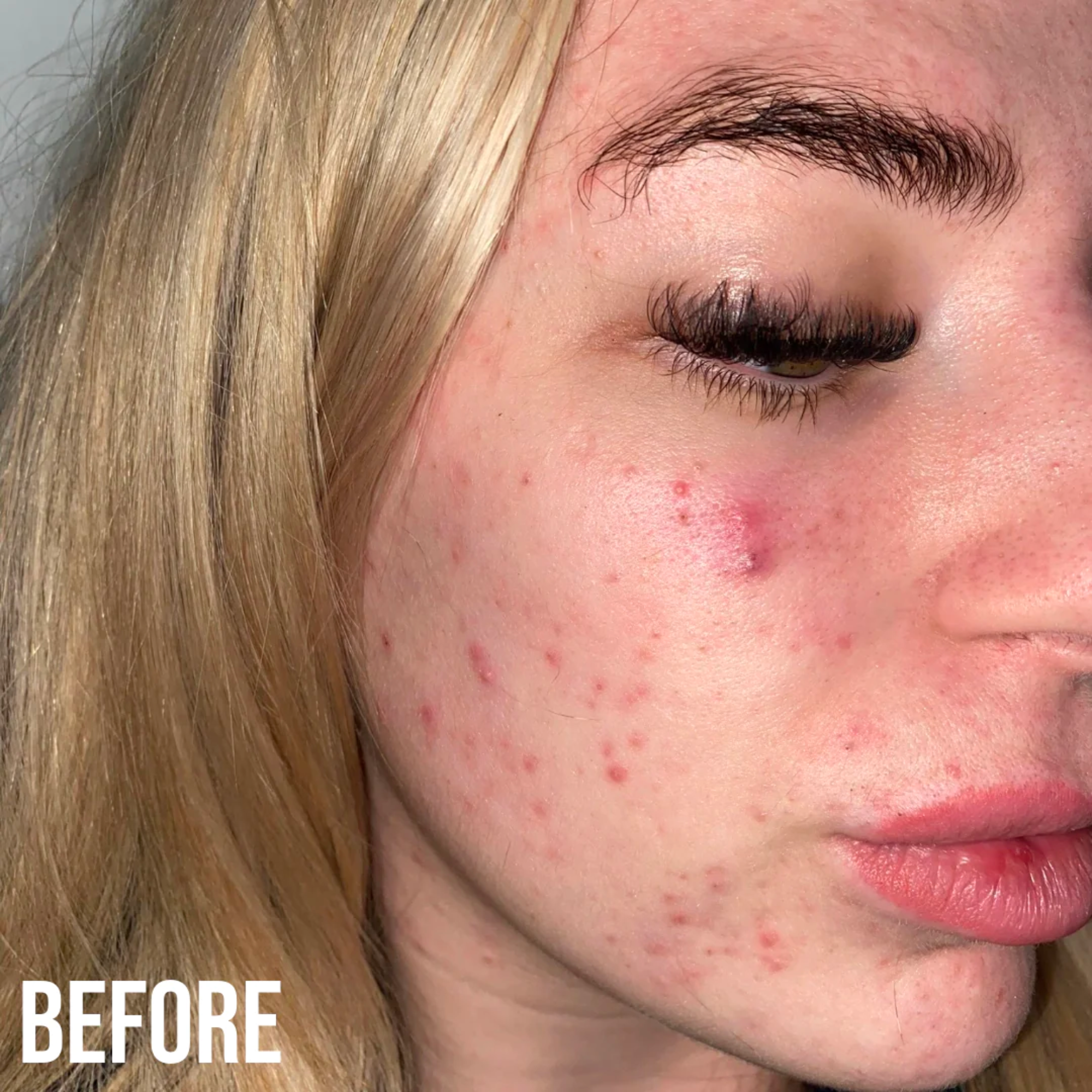 Retinol Fix Blemish Gel Treatment 10%