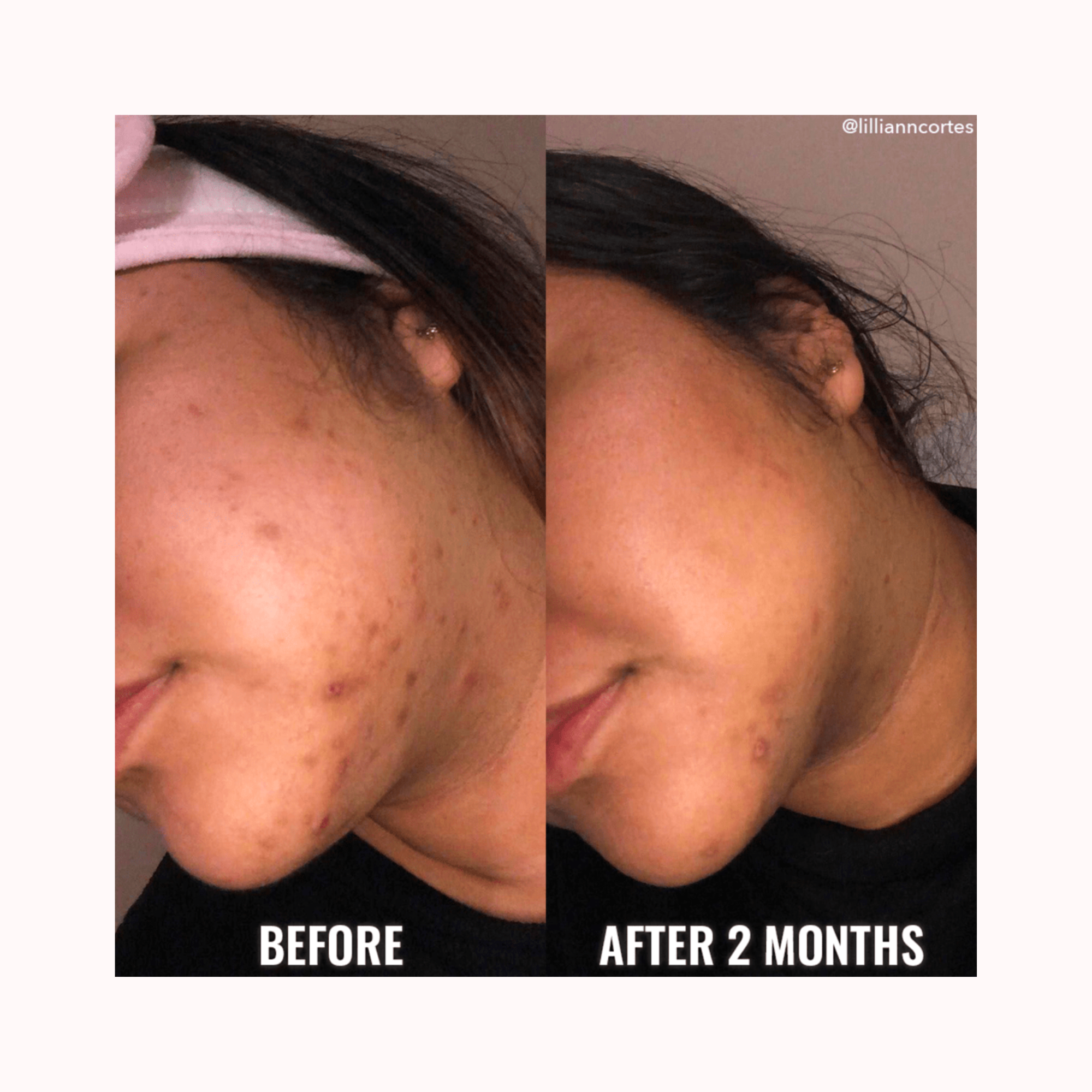 BLEMISH SCAR & DISCOLORATION DUO