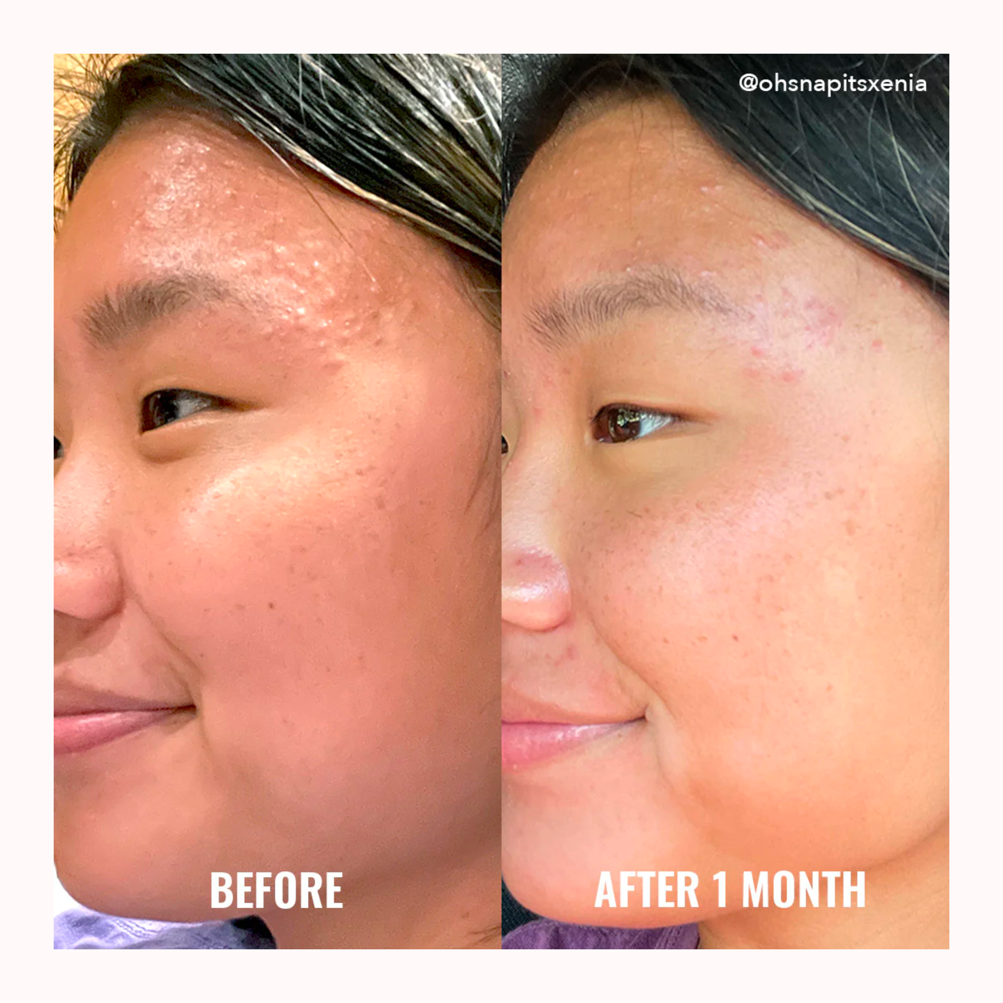Acne Foaming Cleanser