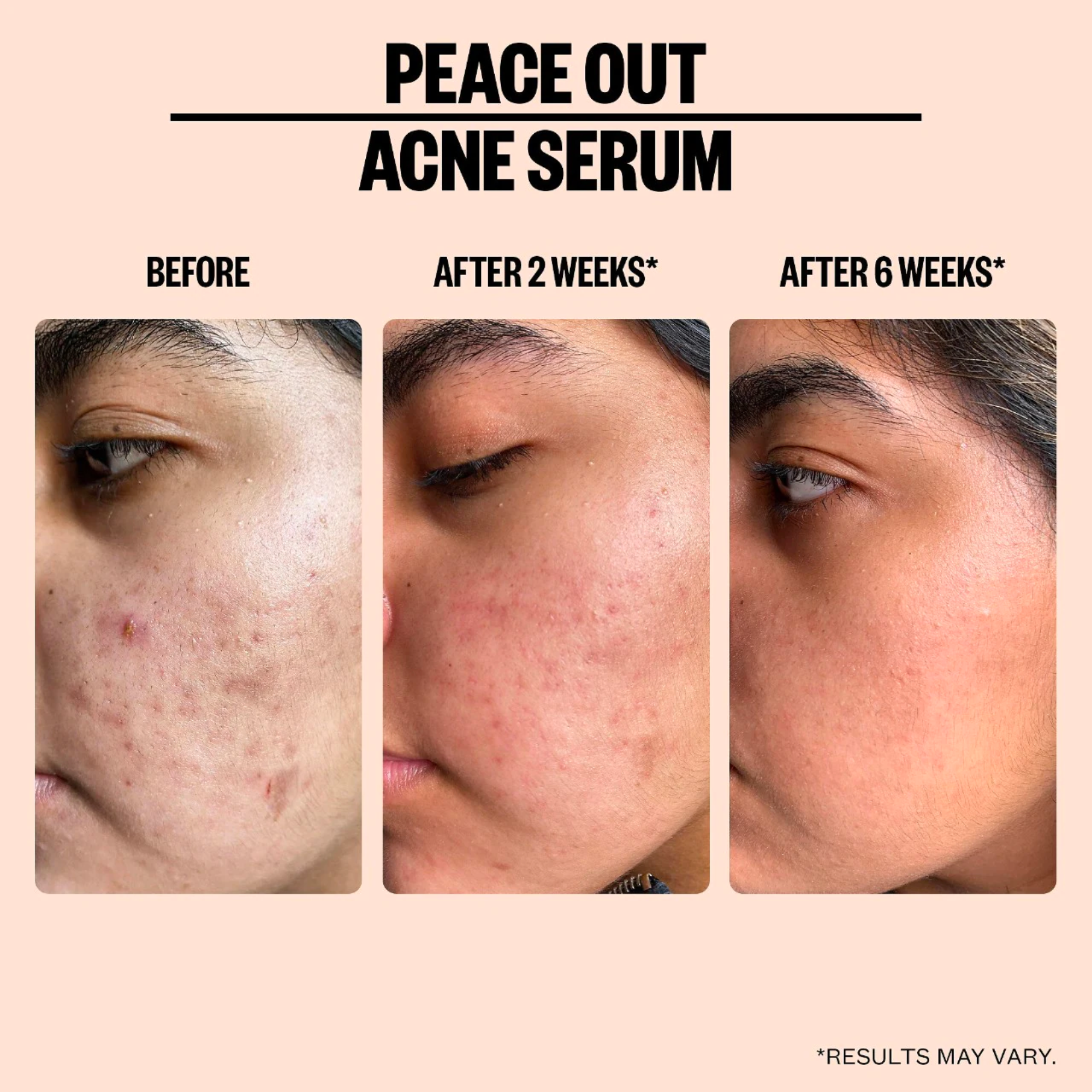 Salicylic Acid Acne Treatment Serum