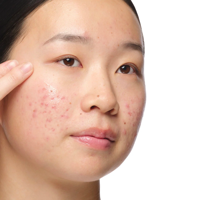 ALOE 2% + NAG 2% SOLUTION