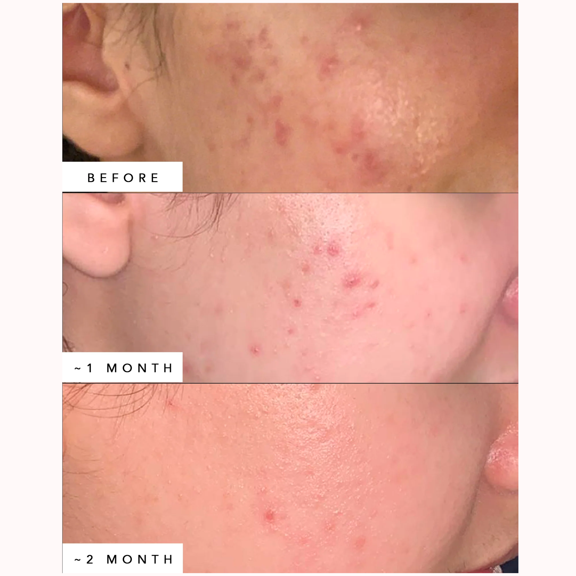 Lapis Blue Tansy Face Oil - For Oily & Acne-Prone Skin