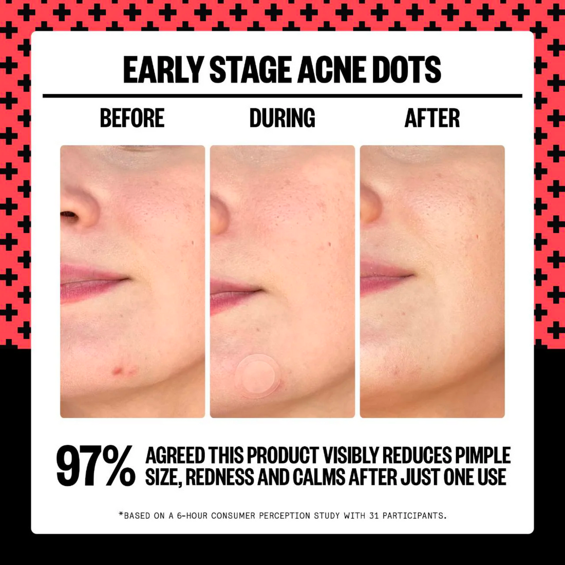 2% Salicylic Acid Early Stage Acne Dot
