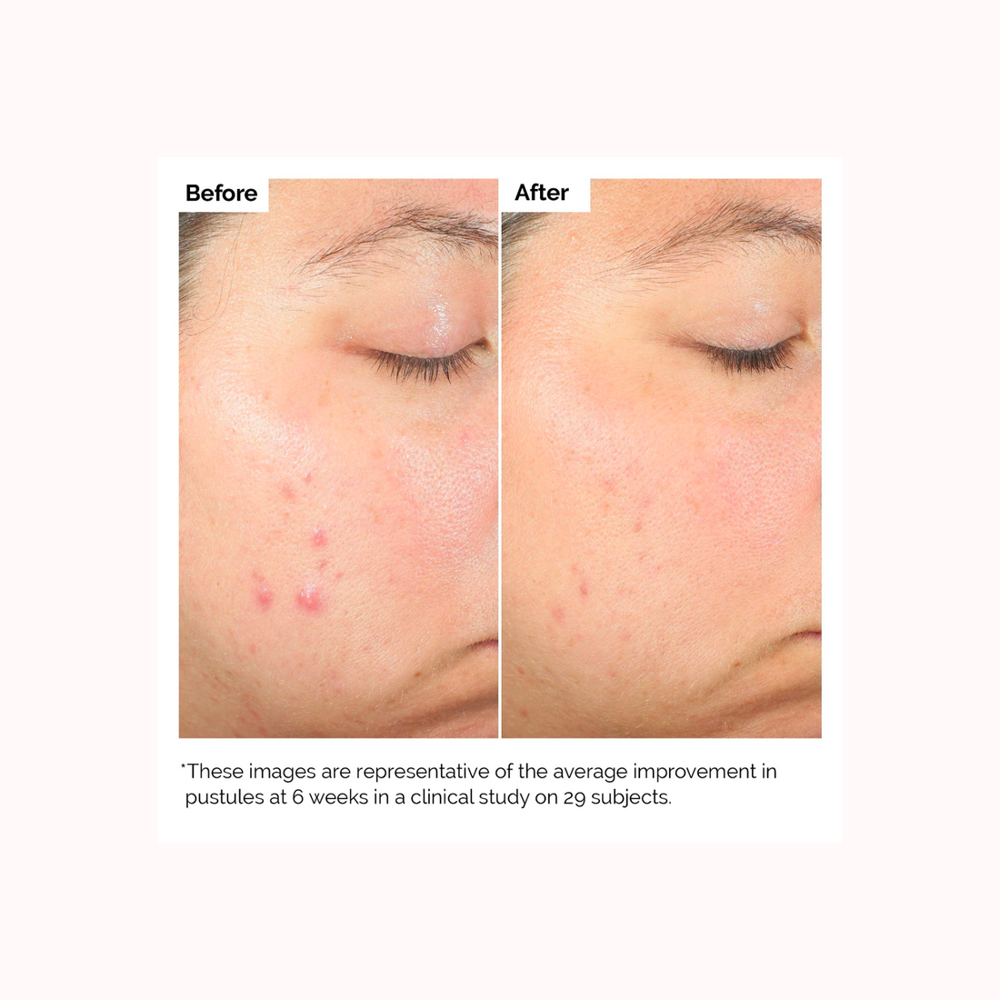 Ácido Salicílico 2% Solución Exfoliante