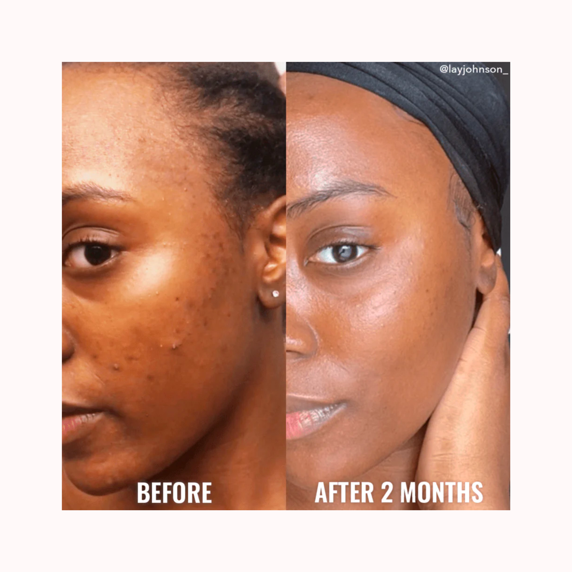 BLEMISH SCAR & DISCOLORATION DUO