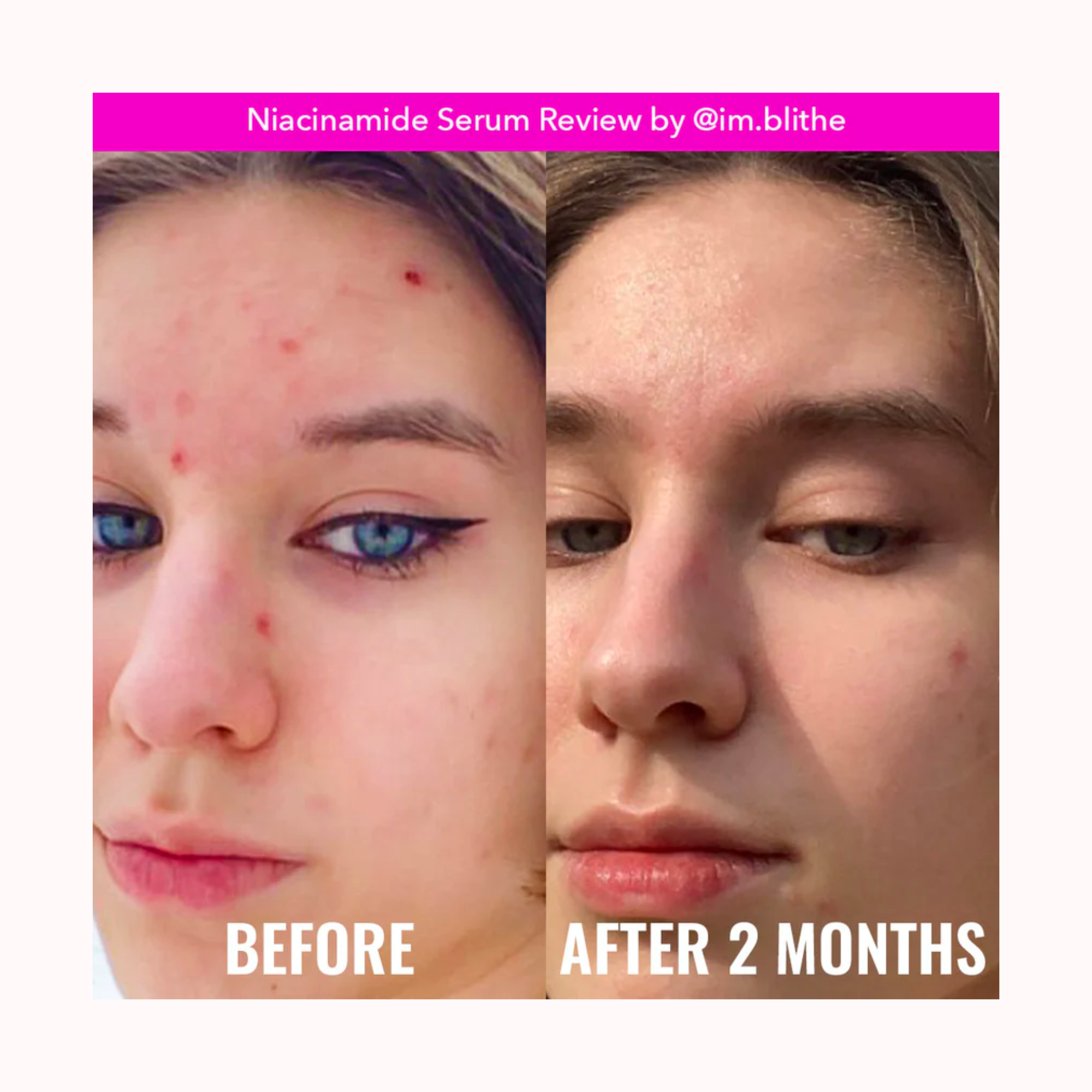 SUERO DE NIACINAMIDA