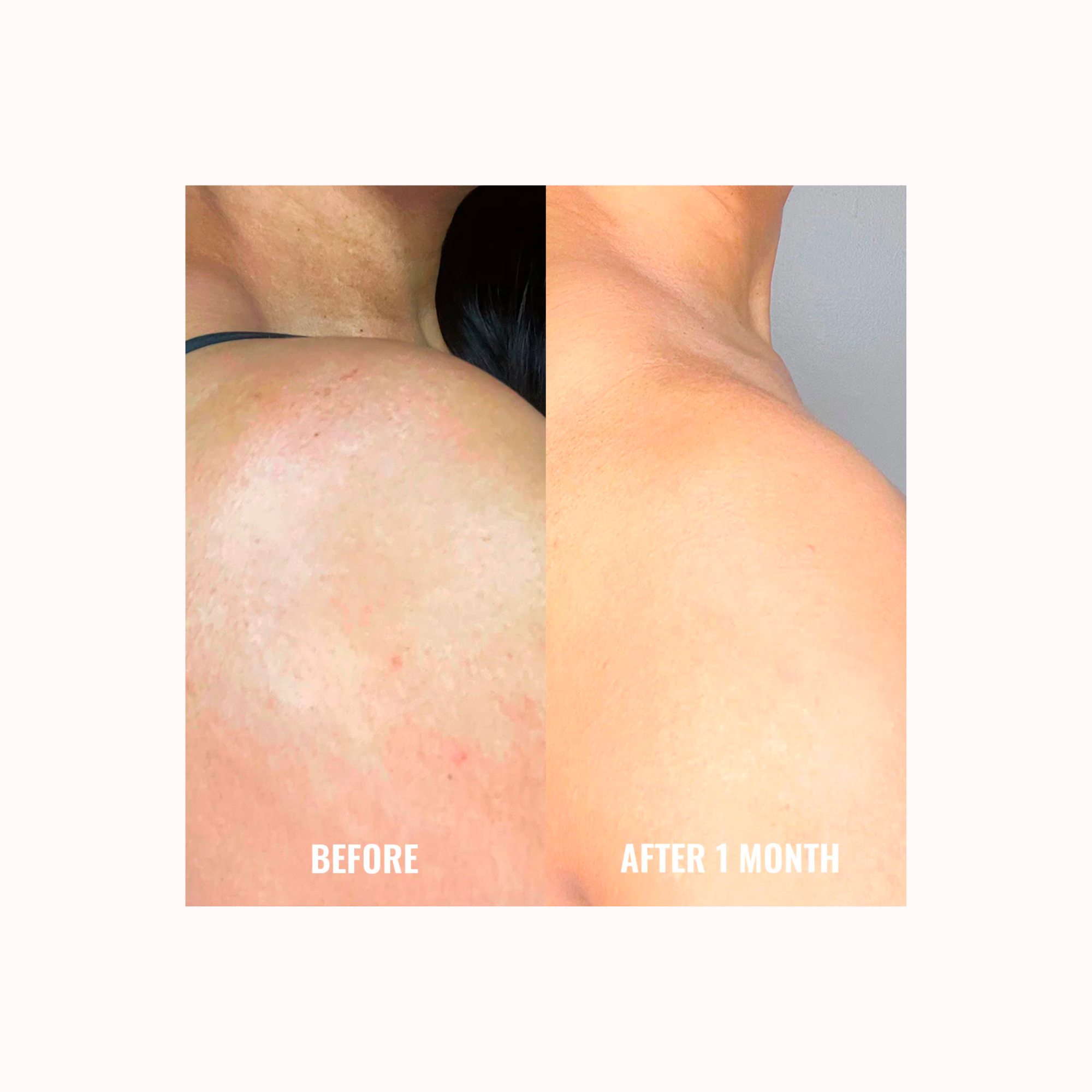 DISCOLORATION CORRECTING BODY TREATMENT (hiperpigmentación)