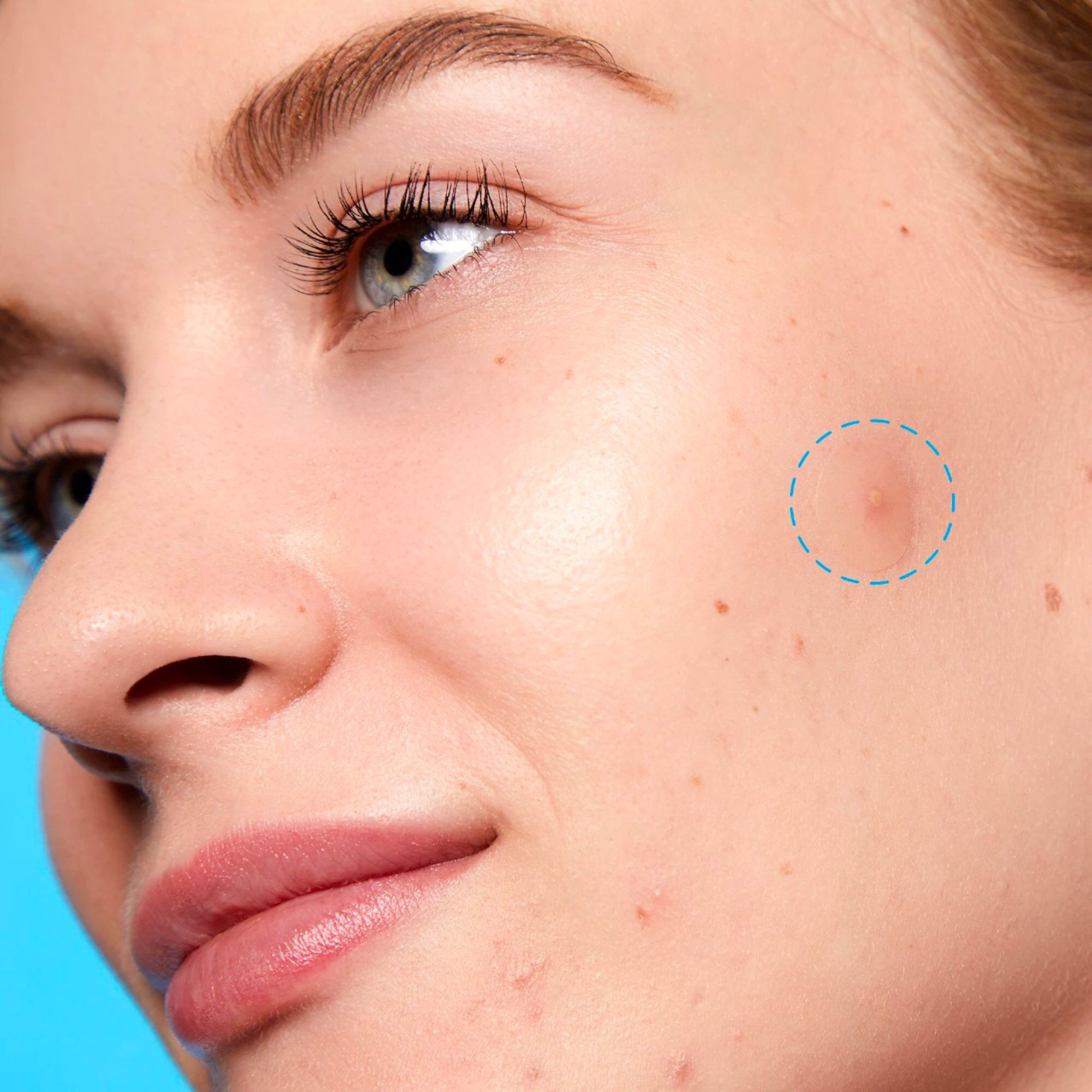 Salicylic Acid Sheer Acne Day Dots