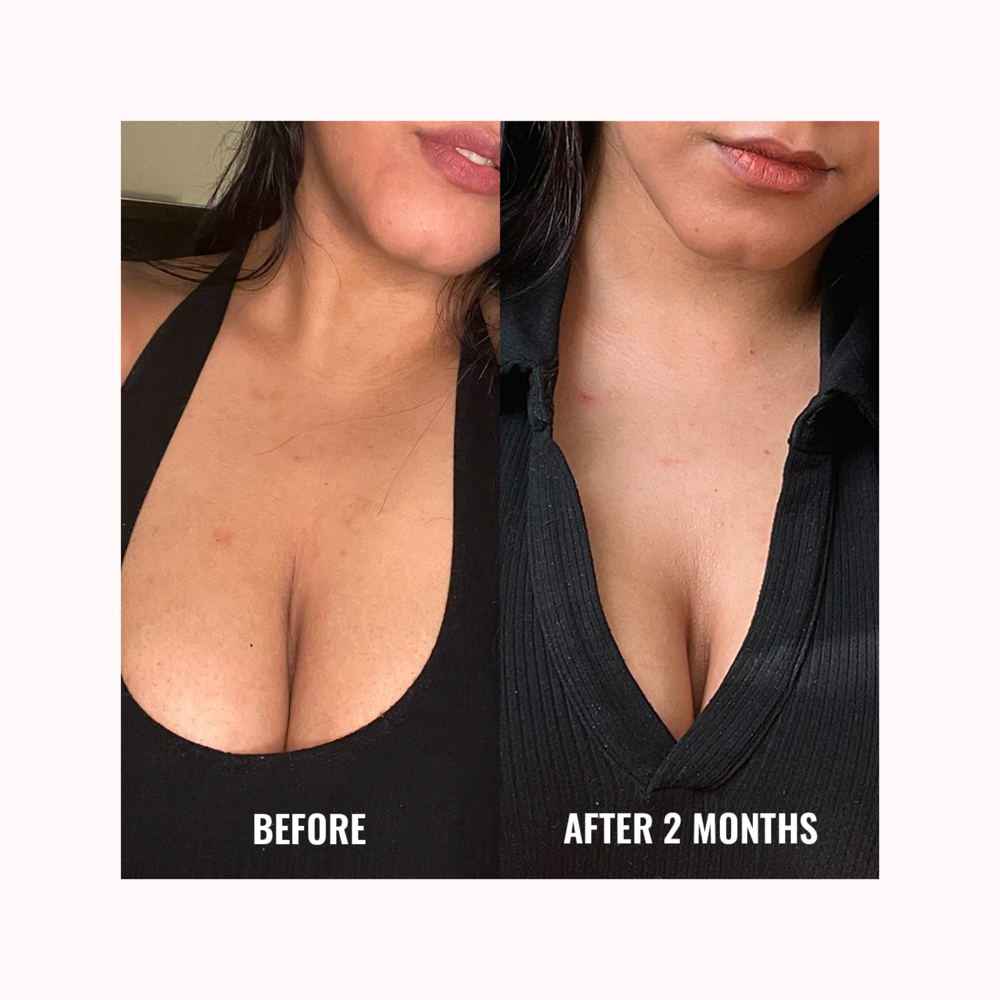 DISCOLORATION CORRECTING BODY TREATMENT (hiperpigmentación)