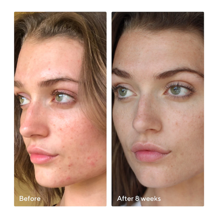 Murad Invisiscar Post-acne Resurfacing Treatment