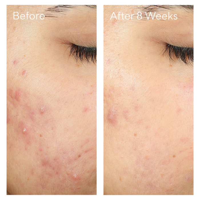 Murad Invisiscar Post-acne Resurfacing Treatment