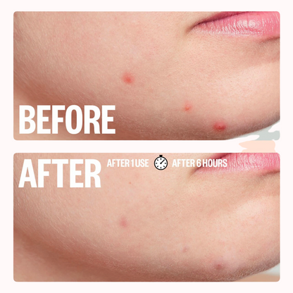 Salicylic Acid Acne Healing Dots