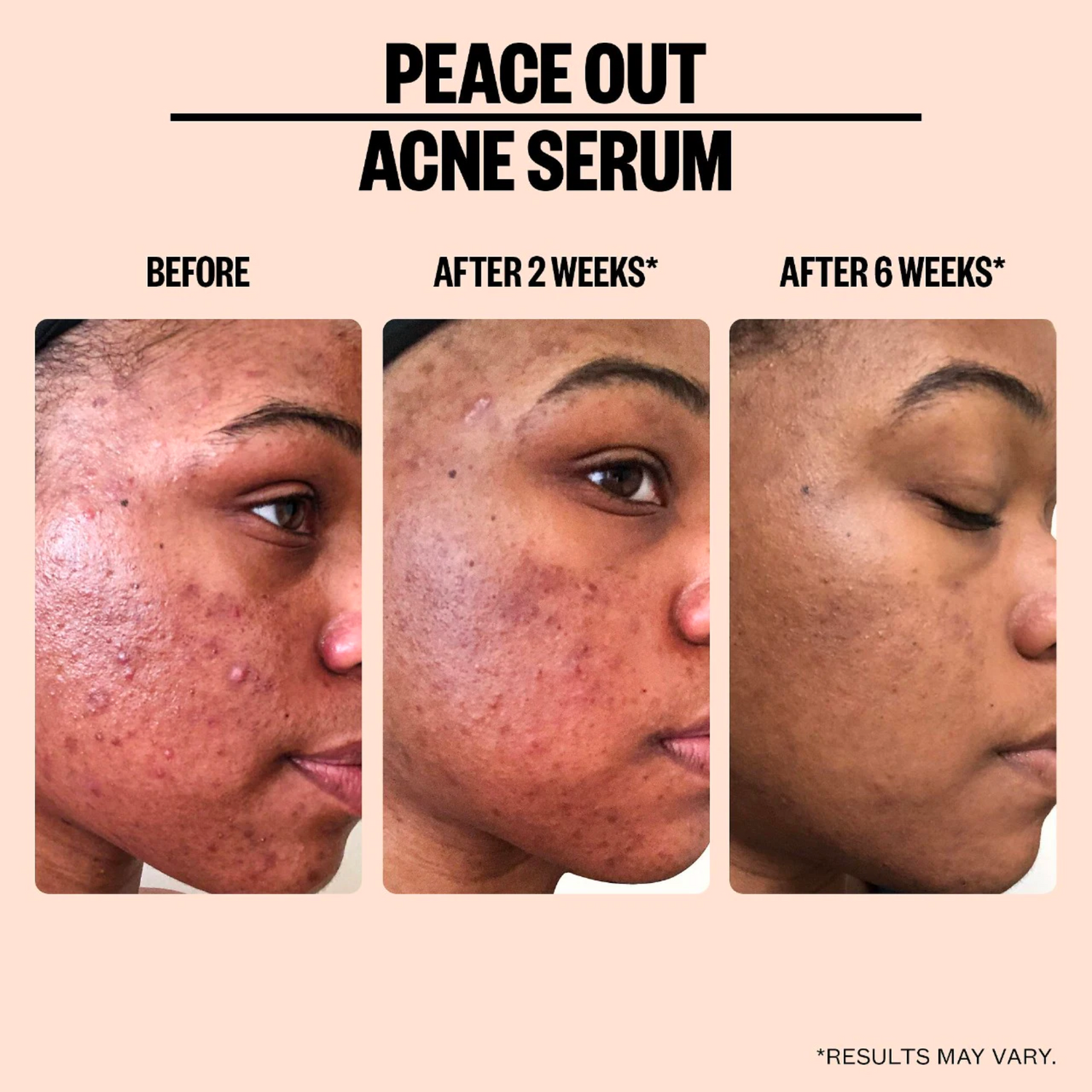 Salicylic Acid Acne Treatment Serum