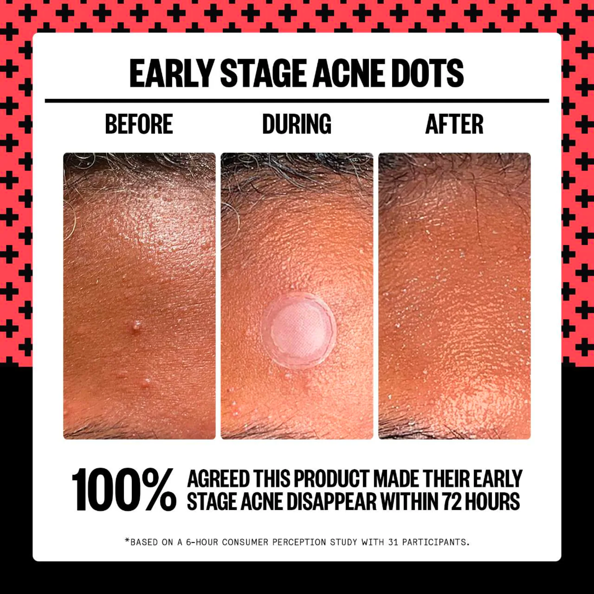 2% Salicylic Acid Early Stage Acne Dot