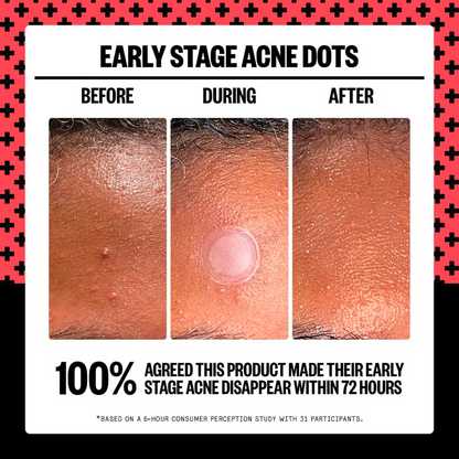 2% Salicylic Acid Early Stage Acne Dot