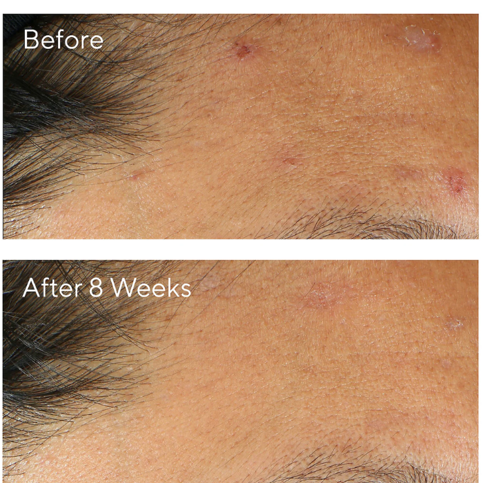 Murad Invisiscar Post-acne Resurfacing Treatment