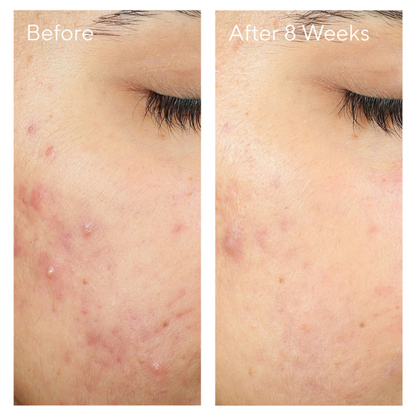 Murad Invisiscar Post-acne Resurfacing Treatment